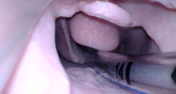 Visualisierung eines schwierigen Atemwegs mit dem Videolaryngoskop VX-35