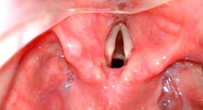Anwendungsbild eines Videolaryngoskops VX-35