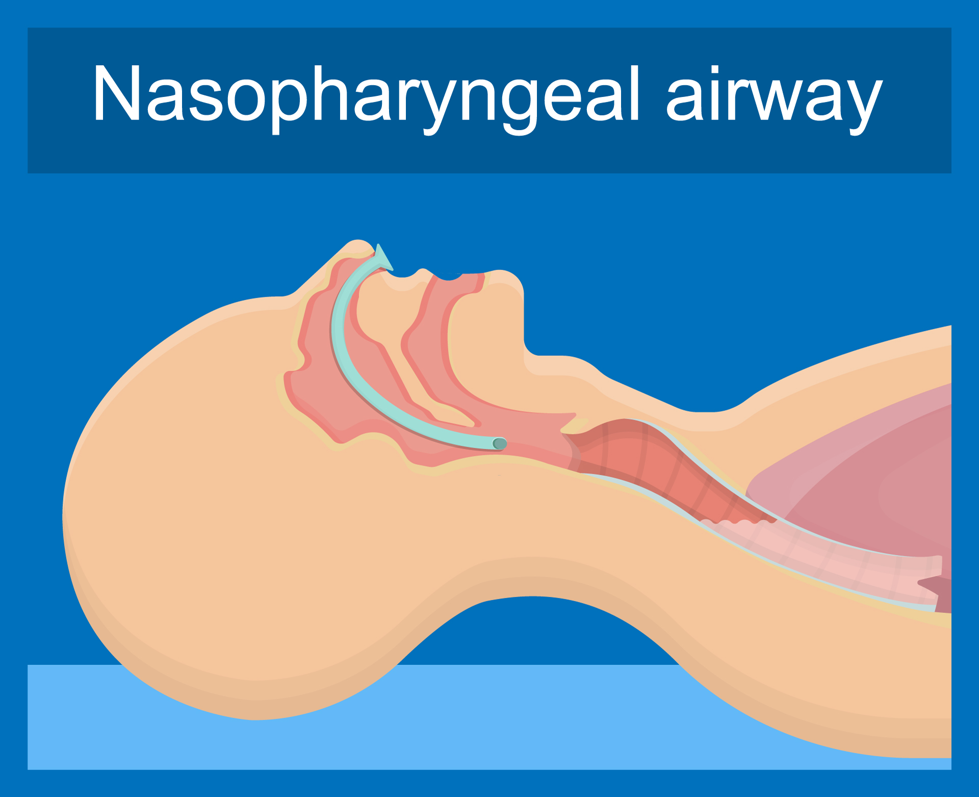 Example of Nasopharyngeal airway